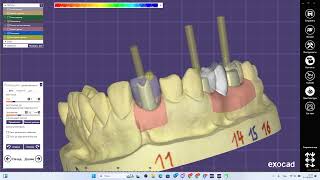 You Wont Believe How Easy EXOCAD Individual Abutment Makes Dental Work [upl. by Leuqim102]