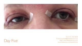 Eyelid Surgery at La Belle Forme [upl. by Aerdnad]