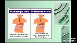 Passagem de SNE Sonda Nasoenteral  Sondagem Nasoenterica [upl. by Ailisab]