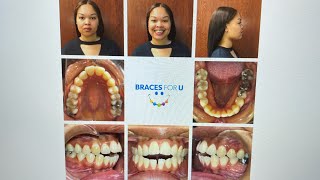 BRACES VLOG 5 12 MONTH UPDATE [upl. by Ennis388]