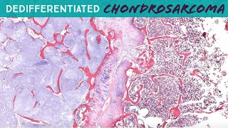 Dedifferentiated Chondrosarcoma with osteosarcoma heterologous area  hemipelvectomy UNC case 7 [upl. by Suirtemid]