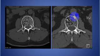 Vertebral Haemangioma [upl. by Irving887]