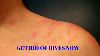 how to get rid of hives on your body [upl. by Ver]