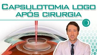 Capsulotomia para limpar a lente logo após cirurgia [upl. by Eelam]