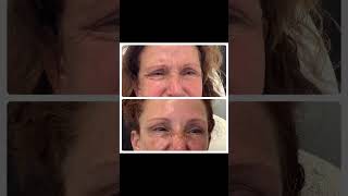 Lower Face Rejuvenation Botox for Platysma amp DAO Muscles aobmedspa medspa botox treatyourself [upl. by Burman]