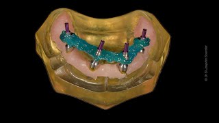 StepbyStep Allon4 Impression Techinique allonX allon4 allon6 fullmouth zygomaticimplants [upl. by Alban]