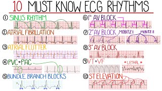 Most Common ECG Patterns You Should Know [upl. by Syxela]