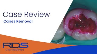 Caries removal [upl. by Lymn]