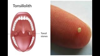 Tonsilloliths tonsil stones a patient education video by Carlo Oller MD [upl. by Orji]