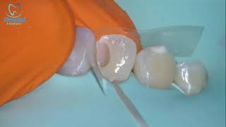 Free hand Class III palatal shell build up [upl. by Aicram]