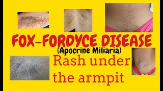 FOXFORDYCE DISEASE or and rashsunder armpit over breastDermatology lecture for MBBS [upl. by Colene]