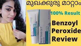 Benzoyl peroxide Review in Malayalam 100 result in 3 days👍 [upl. by Frentz]