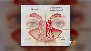 Doctor Tried And True Methods For Sinus Relief Are Still Best [upl. by Hux]