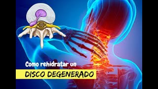 ¿Cómo rehidratar un disco degenerado [upl. by Brunhilda]