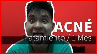 Tratamiento Acné  1 Mes  Doxiciclina  Experiencia [upl. by Nirual865]