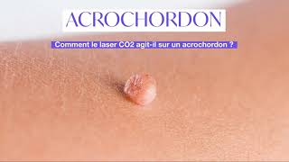 Acrochordons Excroissance de Peau  comment sen débarrasser   Skin Marceau Paris [upl. by Ginevra]