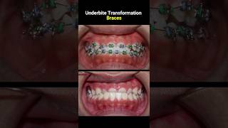 Underbite braces transformation braces orthodontist dentist bracket [upl. by Milburr]