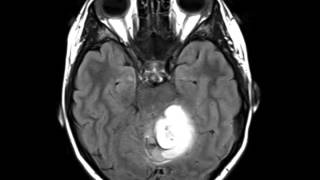 Pilocytic Astrocytoma [upl. by Ande]