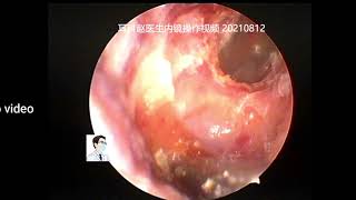 Ear wax removalManagement of a severe external auditory canal cholesteatoma 11 min [upl. by Yelsel]