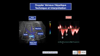 Le Doppler Veineux Hépatique en cardiologie Hepatic Vein Doppler in cardiology [upl. by Niamreg676]