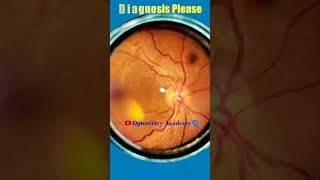 Smartphone Fundus Videography  Fundus Photography  Hypertensive Retinopathy  Short Video 42 [upl. by Colp911]