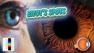 Bitots spots  Your EYEBALLS  EYNTK 👁️💉😳💊🔊💯✅ [upl. by Shayne]