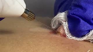 REMOVING GIANT WART WITH PLASMA JET [upl. by Iew]