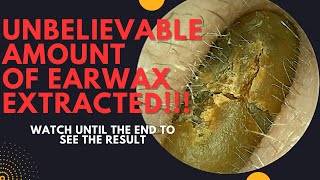 UNBELIEVABLE Amount Of Earwax Extracted From This Ear Watch Until The End [upl. by Nylodam]