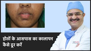 होठों के आसपास का कालापन कैसे दूर करें How To Remove Dark Spots Around Mouth  In HINDI [upl. by Leryt919]