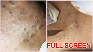 5 Years Old Blackheads Removal  Best Pimple Popping Videos [upl. by Faythe]