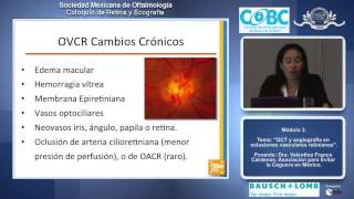 OCT y angiografía en oclusiones vasculares retinianas  Dra Valentina Franco Cárdenas [upl. by Sergei373]