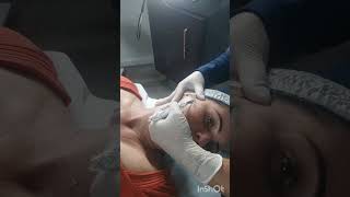 Dermaplaning na prática dermaplaningfacial dermaplaning peeling estetica peelingfacial [upl. by Yrogerg]