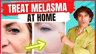 How to Treat MELASMA  Treat DARK SPOTS amp PATCHES on The SKIN [upl. by Neerhtak606]