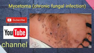 Mycetoma chronic fungal infection [upl. by Royall]