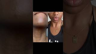 Topicals Faded Serum Before and After skincare hyperpigmentation blemishes topicalsfaded [upl. by Zetnom544]