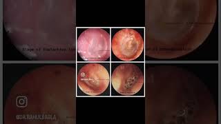 Acute Suppurative Otitis Media  Read more Link in description  Dr Rahul Bagla Teaching ENT [upl. by Ysnat]