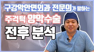 구강악안면외과 전문의s 주걱턱 양악수술 전후로 분석하기 ㅣ 줌구강악안면외과 [upl. by Oderfigis129]