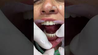 See how this dental prosthesis solves this problem viral mrdent smile dentures prothesis [upl. by Tnilf]