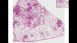 Histopathology LungBronchopneumonia [upl. by Ynamad371]