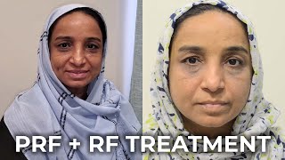 Effective Treatment for Acne Scars PRF  RF Fractional Microneedling  ایکنی اسکارز کا مؤثر علاج [upl. by Christianna]