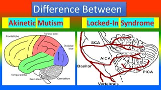 Difference between Akinetic Mutism and Lockin Syndrome [upl. by Dalt]