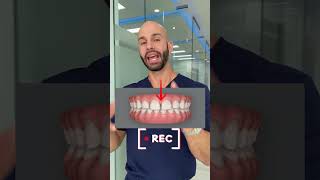 Orthodontist shows how he’ll use Invisalign to close spacesgaps between teeth 2024 [upl. by Afihtan]