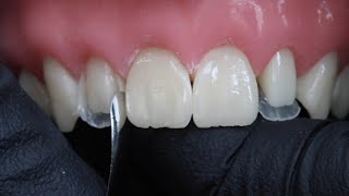 Peg Laterals Restorations with Rhodri Thomas BDS [upl. by Maclean]