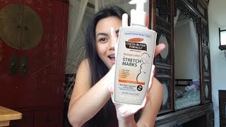 How to Get Rid of Stretch Marks  Palmers Massage Lotion for Stretch Marks Review [upl. by Kopaz289]