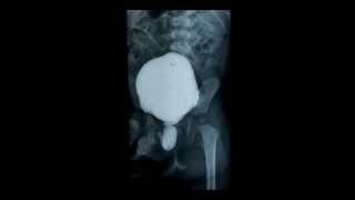 ProfDrPrathap Somnaths quotCashewnut and fruit signquot for posterior urethral valve [upl. by Yankee]