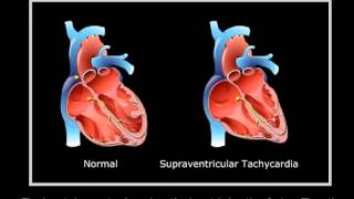 Supraventricular tachycardia [upl. by Thenna]