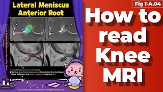 Fig 1A04 Anatomy of lateral Meniscus anterior root tibial spine fracture [upl. by Artenal917]