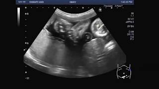 Ultrasound Video showing a rare case of fetal anomaly called Gastroschisis [upl. by Sotos]