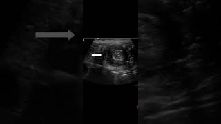 Bulls Eye Mass Lesion in upper abdomen in transverse colon Awerenes of all [upl. by Edwin]