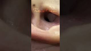 ear infection cleaningearwax earwaxcleaner earwaxremoval trending layraytai [upl. by Renate132]